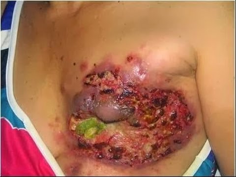 Operasi untuk mengamputasi penis Sembelit dan potensi