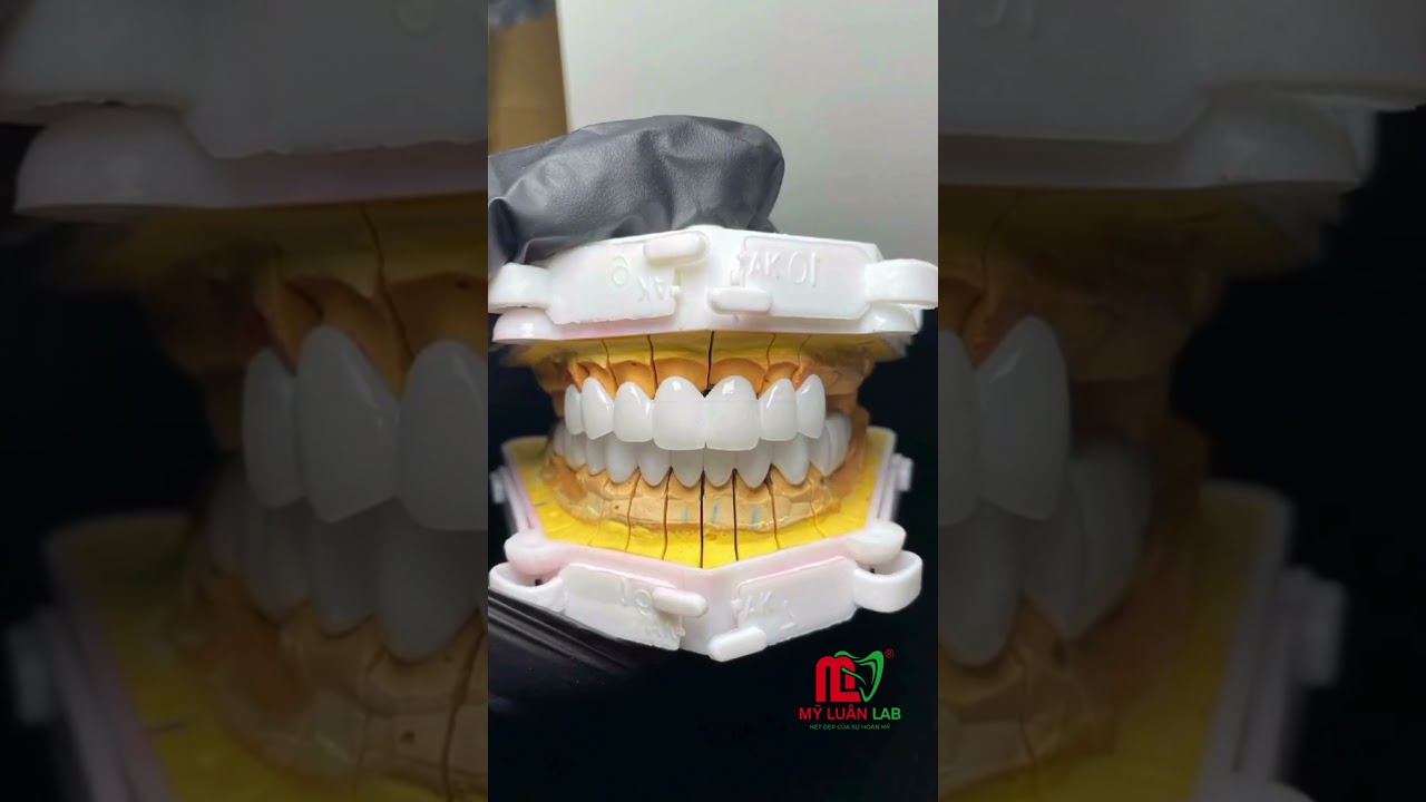 VÌ SAO HT-SMILE ĐƯỢC NHIỀU NHA KHOA LỰA CHỌN?