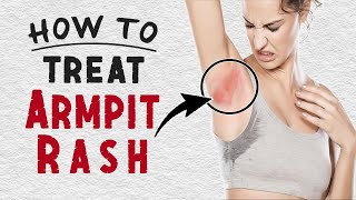 How To Treat Armpit Rash at Home | Home Remedies for Armpit Rash Treatment