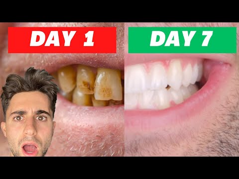I Tried Crest Whitening Strips For 7 Days| INSANE RESULTS (Honest Review)