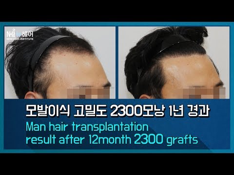 모발이식 4600모 1년 Man hair transplantation (FUSS) result after 12month 2300 grafts (뉴헤어)
