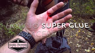 How to Super Glue a Laceration