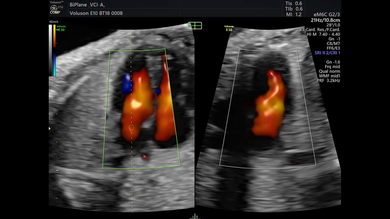 ECOGRAFIA FETAL COM FLUXO EM CORES