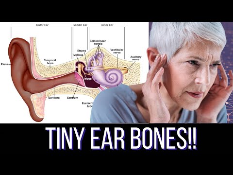 What You Need to Know About Ear Bones (Otosclerosis 101)