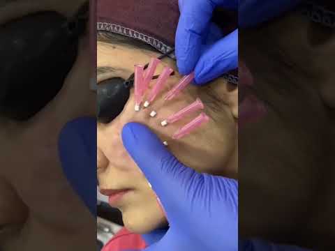 Scar revision Treatment post surgery Treatment