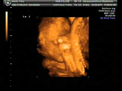 4d Scan 26 Weeks Live Dvd Two Tiny Tots