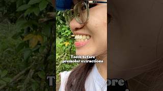 Download lagu Premolar Extractions Before and After #dentalshorts #youtubeshorts  #shorts #braces #viral mp3