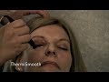 ThermiSmooth Treatment for Eyes