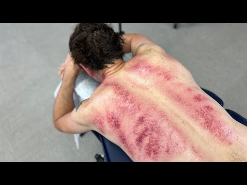 Shocking MARKS 😱 Man's Back Lights Up From Ancient Scraping Technique After ELBOW Massage & *CRACKS*