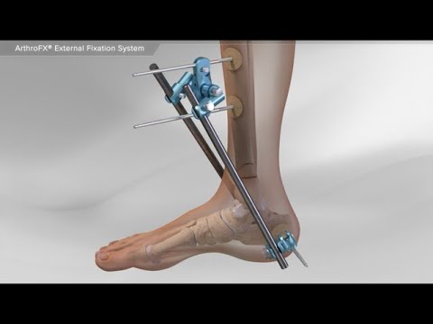 ArthroFX® Externes Fixationssystem