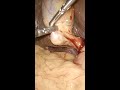 Stone Filled Gallbladder During Laparoscopic Cholecystectomy Shorts