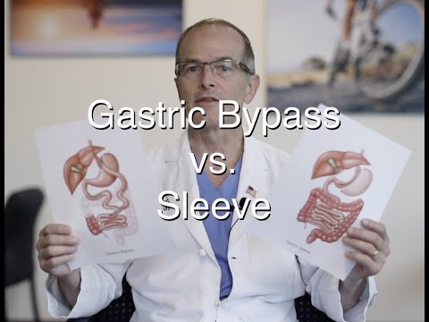Gastric Bypass vs  Sleeve, update for 2021