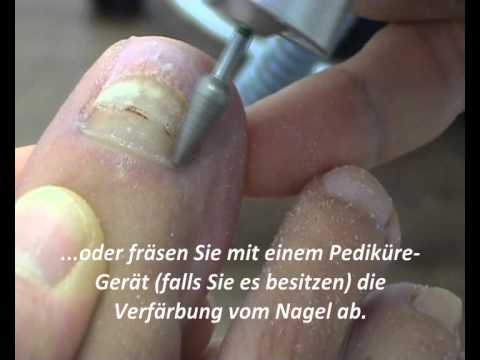 Das Medikament gegen gribka der Nägel der Preis Die Bearbeitung der Nägel mit gribkami von der Essigsäure