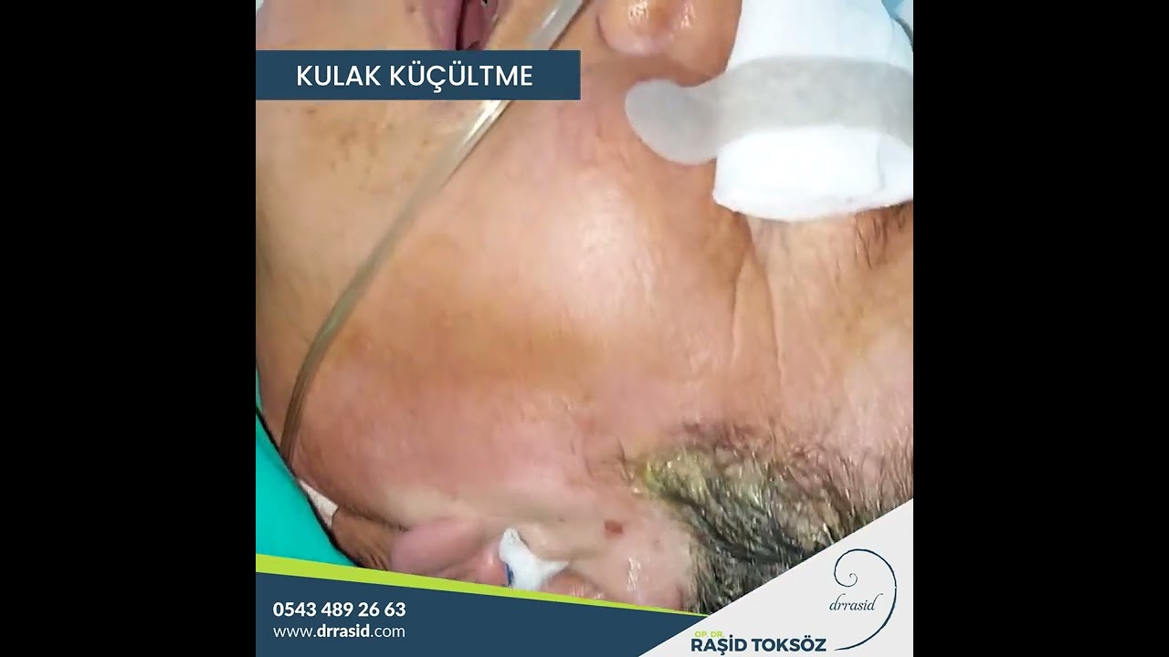 Kulak Küçültme Nedir? Kulak Küçültme Ameliyatı Nasıl Yapılır?