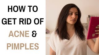 How to get rid of acne | How to get rid of pimples