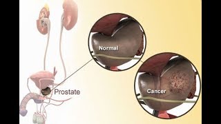 Prostate Cancer Symptoms, Types And Treatment