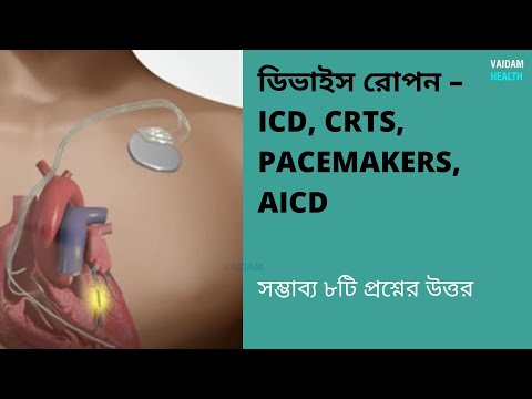 ডিভাইস ইমপ্লান্টেশন -৮ টি প্রায়শই জিজ্ঞাসিত প্রশ্ন