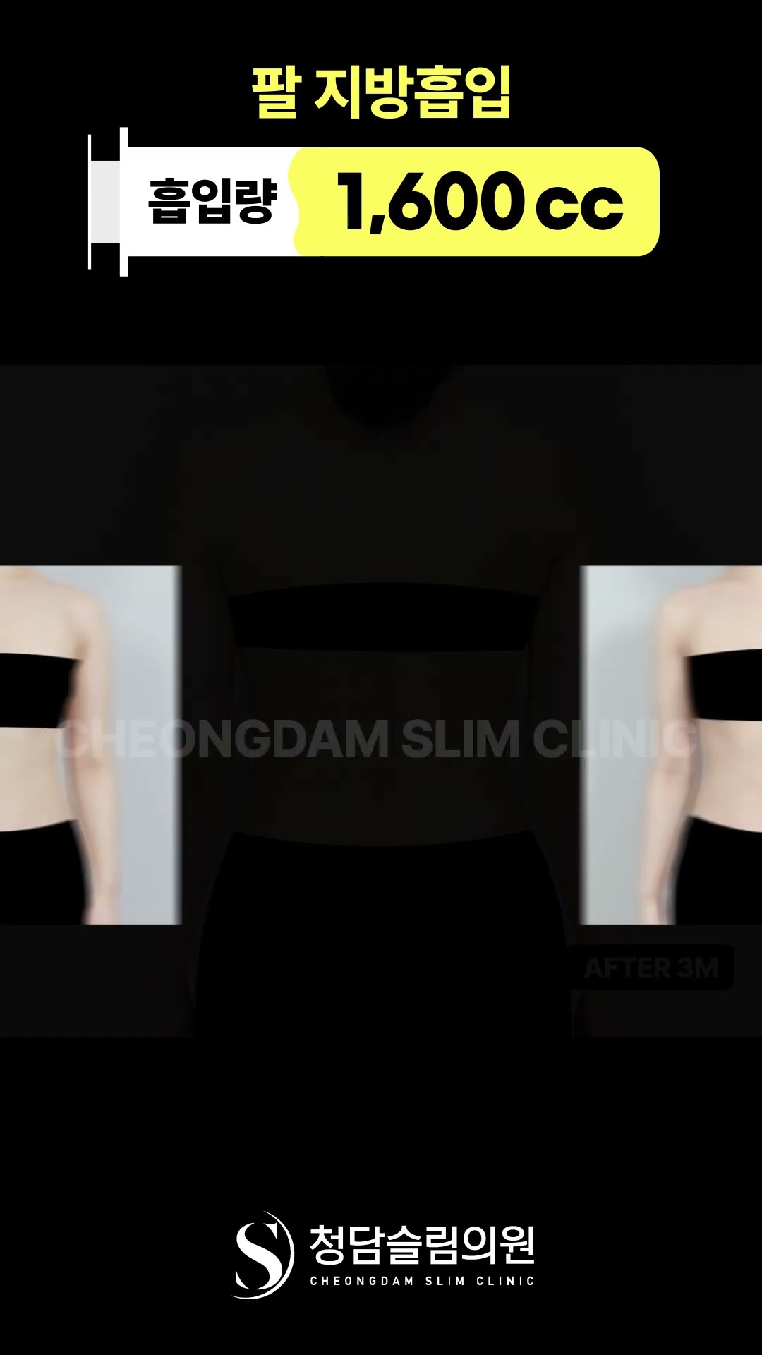 팔뚝 군살 없애니 실루엣이 달라짐