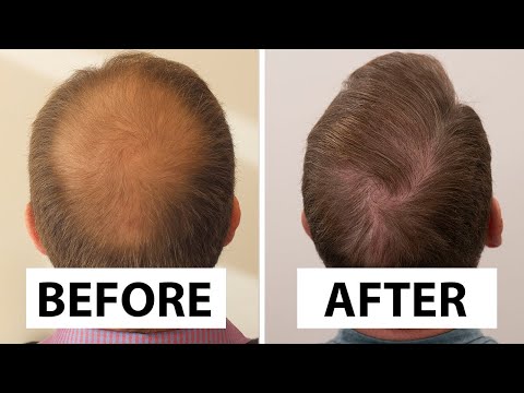 US Patient FUT Hair Transplant, Great Before and After Results - Dr. Ali Emre Karadeniz