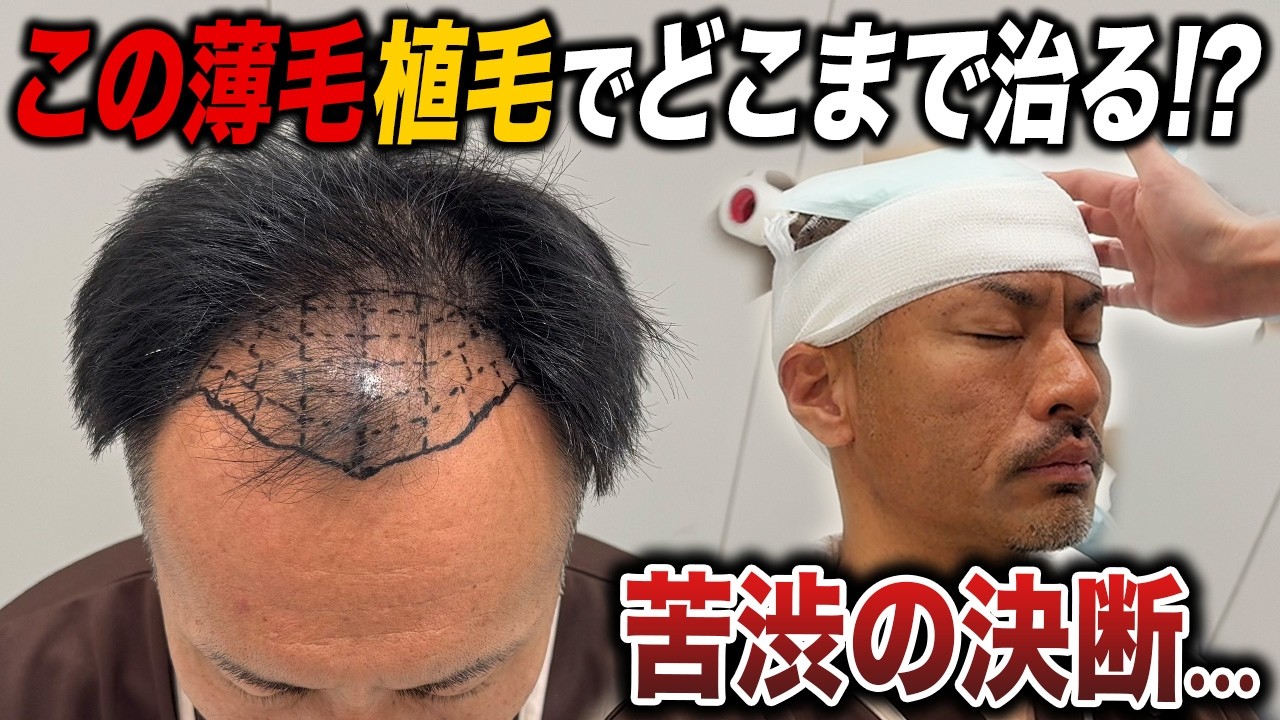 【40代薄毛】治療薬が効かない薄毛は植毛でどこまで治る!?