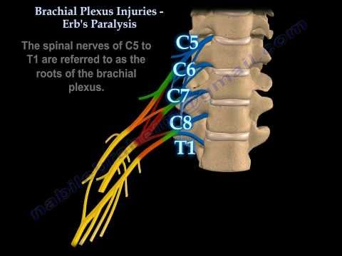 Brachial Plexus Injuries Erb's Paralysis - Everything You Need To Know - Dr. Nabil Ebraheim