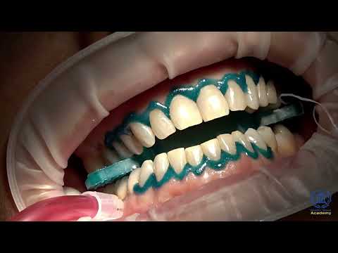 Doctor Smile - Laser Whitening System