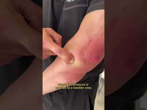 Have You Ever Heard of Pitting Edema?!