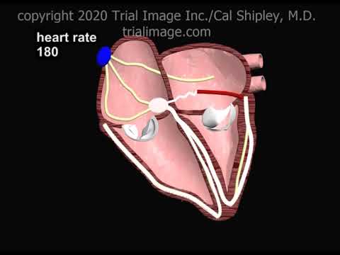 Wolff Parkinson White Syndrome Animation by Cal Shipley, M.D.