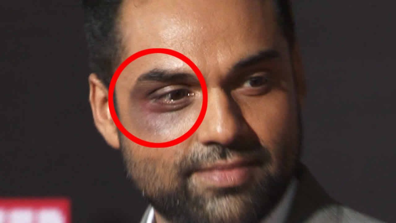 Reason Behind Abhay Deol’s Punched Eye !