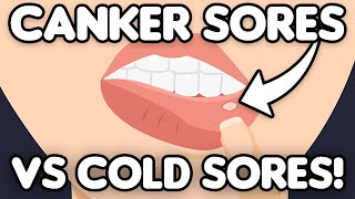 Cold Sores VS Canker Sores