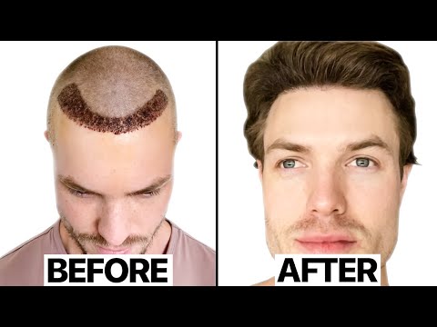 My Hair Transplant Results *6 Months* | Surgeon Reacts