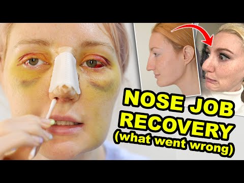 我的隆鼻手術 | 第 2 部分 | 出了什麼問題及我為什麼後悔 (MY NOSE JOB | PART 2 | WHAT WENT WRONG & WHY I REGRET IT)