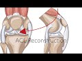 Why does it take so long to recover from an ACL injury?