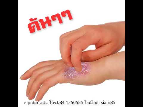 ครีมกับ neurodermatitis ผื่นที่มือของโรคสะเก็ดเงิน