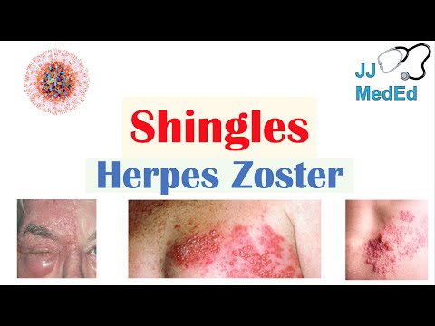 Dr. Diag - Herpes zoster, Papillomavírus netdoktor