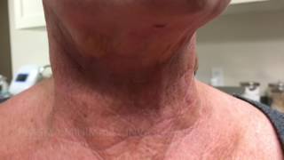 Results from Plasma Minimally Invasive Neck Lift at 6 days after procedure!