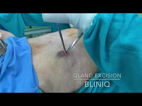Patient Recovery Case — Video 18 (Body Sculpting)
