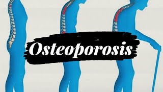 What is Osteoporosis? | Risk factors of Osteoporosis | Prevention of Osteoporosis