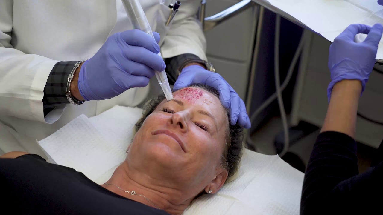 Microneedling and PRP, Procedure Breakdown