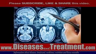 58# Brain Lesions Lesions on the Brain    causes,  symptoms,  diagnosis,  treatment, complications