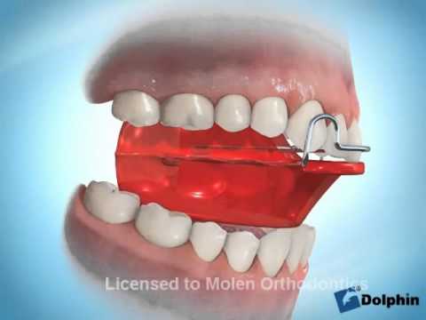 Ortodoncia Maxilar Bionator.wmv