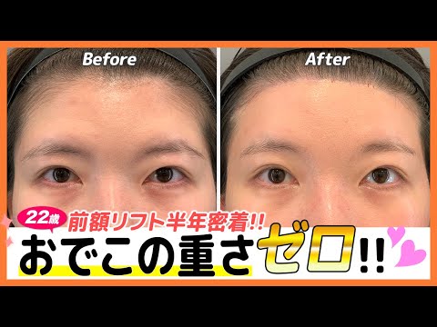 勇気を出してやって良かった！おでこの重さを前額リフトで改善！【切開式前額リフト】