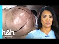 ¡Dra. Sandra Lee remueve bulto de 4 KILOS! | Dra. Sandra Lee: Especialista en piel | Discovery H&H