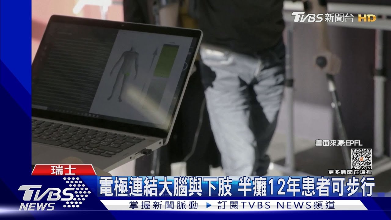 電極「開通」神經!下肢癱瘓12年 病患可自力爬樓梯