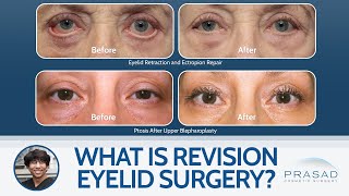 What is Revision Eyelid Surgery?