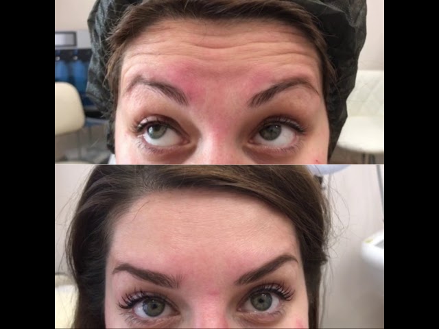 Коррекция морщин ботоксом