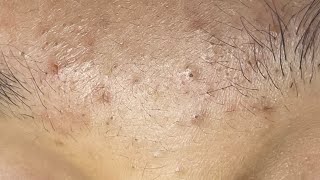 Relaxing Acne Cleansing with LinhMyDang #578 P5