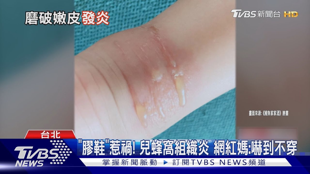 膠鞋惹禍!兒蜂窩組織炎 網紅媽:嚇到不穿