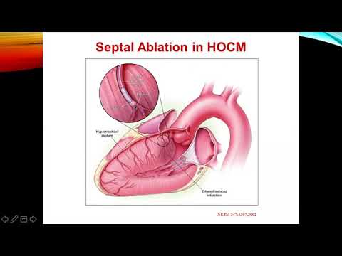 Hypertrophic Cardiomyopathy - Part 2