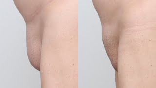 Mons Lipo ISCG